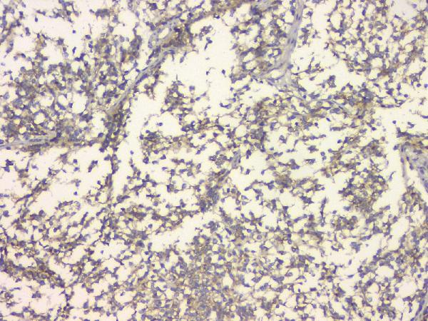 IHC analysis of C99 using anti-C99 antibody (A00081-3). C99 was detected in paraffin-embedded section of human glioma tissue. Heat mediated antigen retrieval was performed in citrate buffer (pH6, epitope retrieval solution) for 20 mins. The tissue section was blocked with 10% goat serum. The tissue section was then incubated with 1μg/ml rabbit anti-C99 Antibody (A00081-3) overnight at 4°C. Biotinylated goat anti-rabbit IgG was used as secondary antibody and incubated for 30 minutes at 37°C. The tissue section was developed using Strepavidin-Biotin-Complex (SABC)(Catalog # SA1022) with DAB as the chromogen.