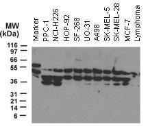 Western blot analysis of NOD2 using primary antibody dilution ratio of 1:2000. 30 ug total protein was loaded per lane. Samples from human tumor cell lines: PPC-1 (prostate carcinoma), NCI-H226 and NCI-H332M (lung carcinoma), SF-268 (glioblastoma), UO-31 and A498 (renal/kidney carcinoma), SK-MEL-5 and SK-MEL-28 (melanoma), and MCF-7 (breast carcinoma). Lymphoma is from a cell line generated from a tumor growing in nude mice following injection of primary human lymphoma cells.