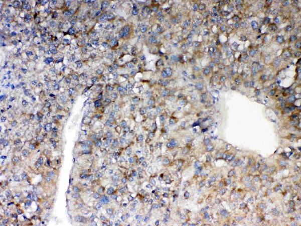 IHC analysis of MAVS using anti-MAVS antibody (A00169-1). MAVS was detected in paraffin-embedded section of human liver cancer tissue. Heat mediated antigen retrieval was performed in citrate buffer (pH6, epitope retrieval solution) for 20 mins. The tissue section was blocked with 10% goat serum. The tissue section was then incubated with 1μg/ml rabbit anti-MAVS Antibody (A00169-1) overnight at 4°C. Biotinylated goat anti-rabbit IgG was used as secondary antibody and incubated for 30 minutes at 37°C. The tissue section was developed using Strepavidin-Biotin-Complex (SABC)(Catalog # SA1022) with DAB as the chromogen.