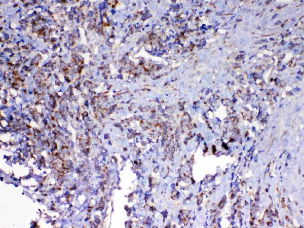 IHC analysis of MAVS using anti-MAVS antibody (A00169-1). MAVS was detected in paraffin-embedded section of human lung cancer tissue. Heat mediated antigen retrieval was performed in citrate buffer (pH6, epitope retrieval solution) for 20 mins. The tissue section was blocked with 10% goat serum. The tissue section was then incubated with 1μg/ml rabbit anti-MAVS Antibody (A00169-1) overnight at 4°C. Biotinylated goat anti-rabbit IgG was used as secondary antibody and incubated for 30 minutes at 37°C. The tissue section was developed using Strepavidin-Biotin-Complex (SABC)(Catalog # SA1022) with DAB as the chromogen.