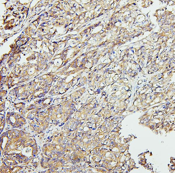 Figure 3. IHC analysis of CETP using anti-CETP antibody (A00309-1). CETP was detected in paraffin-embedded section of human gastric cancer tissues. Heat mediated antigen retrieval was performed in citrate buffer (pH6, epitope retrieval solution) for 20 mins. The tissue section was blocked with 10% goat serum. The tissue section was then incubated with 1microg/ml rabbit anti-CETP Antibody (A00309-1) overnight at 4°C. Biotinylated goat anti-rabbit IgG was used as secondary antibody and incubated for 30 minutes at 37°C. The tissue section was developed using Strepavidin-Biotin-Complex (SABC)(Catalog # SA1022) with DAB as the chromogen.
