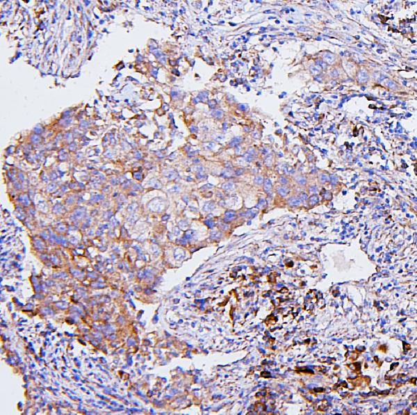Figure 5. IHC analysis of CETP using anti-CETP antibody (A00309-1). CETP was detected in paraffin-embedded section of human mammary cancer tissues. Heat mediated antigen retrieval was performed in citrate buffer (pH6, epitope retrieval solution) for 20 mins. The tissue section was blocked with 10% goat serum. The tissue section was then incubated with 1microg/ml rabbit anti-CETP Antibody (A00309-1) overnight at 4°C. Biotinylated goat anti-rabbit IgG was used as secondary antibody and incubated for 30 minutes at 37°C. The tissue section was developed using Strepavidin-Biotin-Complex (SABC)(Catalog # SA1022) with DAB as the chromogen.