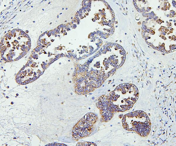 Figure 6. IHC analysis of CETP using anti-CETP antibody (A00309-1). CETP was detected in paraffin-embedded section of human Ovarian cancer tissues. Heat mediated antigen retrieval was performed in citrate buffer (pH6, epitope retrieval solution) for 20 mins. The tissue section was blocked with 10% goat serum. The tissue section was then incubated with 1microg/ml rabbit anti-CETP Antibody (A00309-1) overnight at 4°C. Biotinylated goat anti-rabbit IgG was used as secondary antibody and incubated for 30 minutes at 37°C. The tissue section was developed using Strepavidin-Biotin-Complex (SABC)(Catalog # SA1022) with DAB as the chromogen.