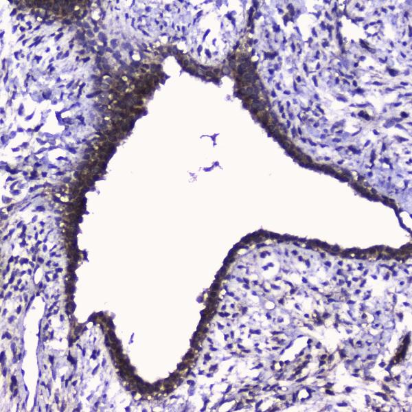 IHC analysis of Cdk6 using anti-Cdk6 antibody (A00358). Cdk6 was detected in paraffin-embedded section of human mammary cancer tissue. Heat mediated antigen retrieval was performed in citrate buffer (pH6, epitope retrieval solution) for 20 mins. The tissue section was blocked with 10% goat serum. The tissue section was then incubated with 2μg/ml rabbit anti-Cdk6 Antibody (A00358) overnight at 4℃. Biotinylated goat anti-rabbit IgG was used as secondary antibody and incubated for 30 minutes at 37℃. The tissue section was developed using Strepavidin-Biotin-Complex (SABC)(Catalog # SA1022) with DAB as the chromogen.