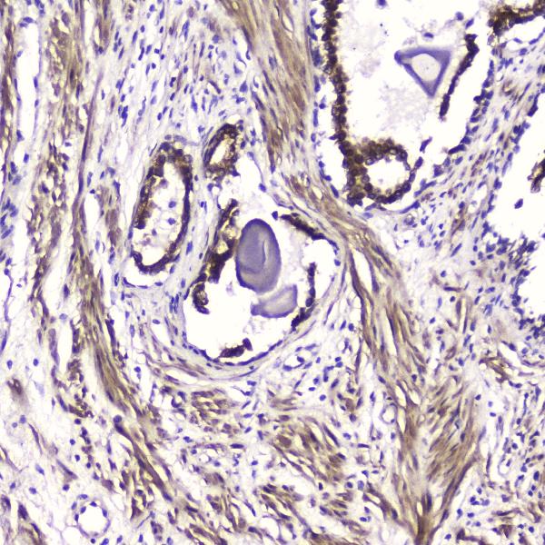IHC analysis of ATF4 using anti-ATF4 antibody (A00371-1). ATF4 was detected in paraffin-embedded section of human prostatic cancer tissue. Heat mediated antigen retrieval was performed in citrate buffer (pH6, epitope retrieval solution) for 20 mins. The tissue section was blocked with 10% goat serum. The tissue section was then incubated with 2μg/ml rabbit anti-ATF4 Antibody (A00371-1) overnight at 4℃. Biotinylated goat anti-rabbit IgG was used as secondary antibody and incubated for 30 minutes at 37℃. The tissue section was developed using Strepavidin-Biotin-Complex (SABC)(Catalog # SA1022) with DAB as the chromogen.