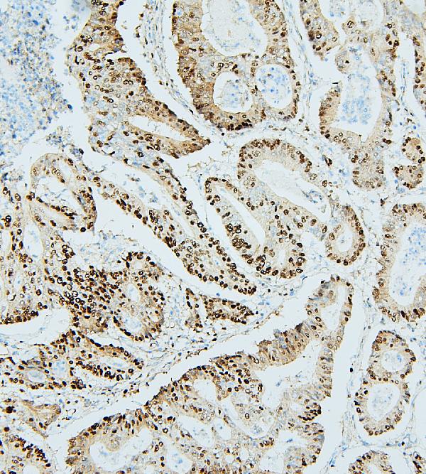Figure 2. IHC analysis of MCM2 using anti-MCM2 antibody (A00374-1). MCM2 was detected in paraffin-embedded section of human intestinal cancer tissues. Heat mediated antigen retrieval was performed in citrate buffer (pH6, epitope retrieval solution) for 20 mins. The tissue section was blocked with 10% goat serum. The tissue section was then incubated with 1microg/ml rabbit anti-MCM2 Antibody (A00374-1) overnight at 4°C. Biotinylated goat anti-rabbit IgG was used as secondary antibody and incubated for 30 minutes at 37°C. The tissue section was developed using Strepavidin-Biotin-Complex (SABC)(Catalog # SA1022) with DAB as the chromogen.