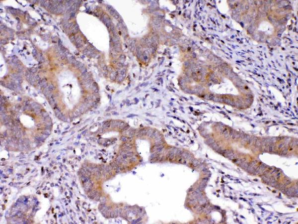 IHC analysis of Cdc20 using anti-Cdc20 antibody (A00382-1). Cdc20 was detected in paraffin-embedded section of human colon cancer tissue. Heat mediated antigen retrieval was performed in citrate buffer (pH6, epitope retrieval solution) for 20 mins. The tissue section was blocked with 10% goat serum. The tissue section was then incubated with 1ug/ml rabbit anti-Cdc20 Antibody (A00382-1) overnight at 4 Biotinylated goat anti-rabbit IgG was used as secondary antibody and incubated for 30 minutes at 37 The tissue section was developed using Strepavidin-Biotin-Complex (SABC)(Catalog # SA1022) with DAB as the chromogen.