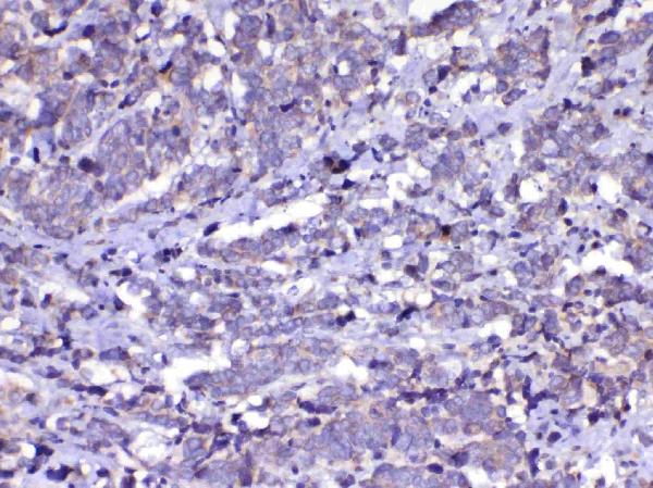 IHC analysis of Cdc20 using anti-Cdc20 antibody (A00382-1). Cdc20 was detected in paraffin-embedded section of human lung cancer tissue. Heat mediated antigen retrieval was performed in citrate buffer (pH6, epitope retrieval solution) for 20 mins. The tissue section was blocked with 10% goat serum. The tissue section was then incubated with 1ug/ml rabbit anti-Cdc20 Antibody (A00382-1) overnight at 4 Biotinylated goat anti-rabbit IgG was used as secondary antibody and incubated for 30 minutes at 37 The tissue section was developed using Strepavidin-Biotin-Complex (SABC)(Catalog # SA1022) with DAB as the chromogen.