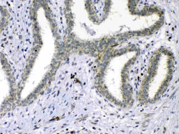 IHC analysis of Cdc20 using anti-Cdc20 antibody (A00382-1). Cdc20 was detected in paraffin-embedded section of human mammary cancer tissue. Heat mediated antigen retrieval was performed in citrate buffer (pH6, epitope retrieval solution) for 20 mins. The tissue section was blocked with 10% goat serum. The tissue section was then incubated with 1ug/ml rabbit anti-Cdc20 Antibody (A00382-1) overnight at 4 Biotinylated goat anti-rabbit IgG was used as secondary antibody and incubated for 30 minutes at 37 The tissue section was developed using Strepavidin-Biotin-Complex (SABC)(Catalog # SA1022) with DAB as the chromogen.