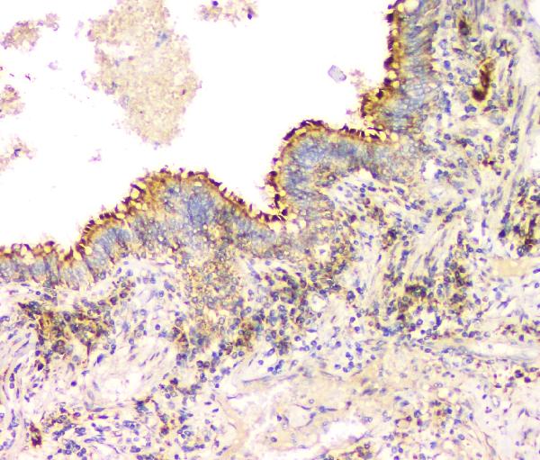 IHC analysis of IFNG using anti-IFNG antibody (A00393-3). IFNG was detected in paraffin-embedded section of human lung cancer tissue. Heat mediated antigen retrieval was performed in citrate buffer (pH6, epitope retrieval solution) for 20 mins. The tissue section was blocked with 10% goat serum. The tissue section was then incubated with 1μg/ml rabbit anti-IFNG Antibody (A00393-3) overnight at 4°C. Biotinylated goat anti-rabbit IgG was used as secondary antibody and incubated for 30 minutes at 37°C. The tissue section was developed using Strepavidin-Biotin-Complex (SABC)(Catalog # SA1022) with DAB as the chromogen.