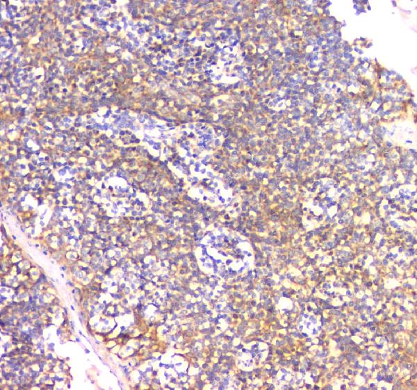 IHC analysis of IFNG using anti-IFNG antibody (A00393-3). IFNG was detected in paraffin-embedded section of human tonsil tissue. Heat mediated antigen retrieval was performed in citrate buffer (pH6, epitope retrieval solution) for 20 mins. The tissue section was blocked with 10% goat serum. The tissue section was then incubated with 1μg/ml rabbit anti-IFNG Antibody (A00393-3) overnight at 4°C. Biotinylated goat anti-rabbit IgG was used as secondary antibody and incubated for 30 minutes at 37°C. The tissue section was developed using Strepavidin-Biotin-Complex (SABC)(Catalog # SA1022) with DAB as the chromogen.