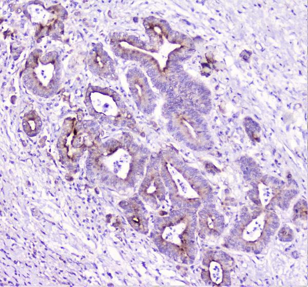 IHC analysis of TANK using anti-TANK antibody (A00445-3). TANK was detected in paraffin-embedded section of human cholangiocarcinoma tissue. Heat mediated antigen retrieval was performed in citrate buffer (pH6, epitope retrieval solution) for 20 mins. The tissue section was blocked with 10% goat serum. The tissue section was then incubated with 1μg/ml rabbit anti-TANK Antibody (A00445-3) overnight at 4°C. Biotinylated goat anti-rabbit IgG was used as secondary antibody and incubated for 30 minutes at 37°C. The tissue section was developed using Strepavidin-Biotin-Complex (SABC)(Catalog # SA1022) with DAB as the chromogen.
