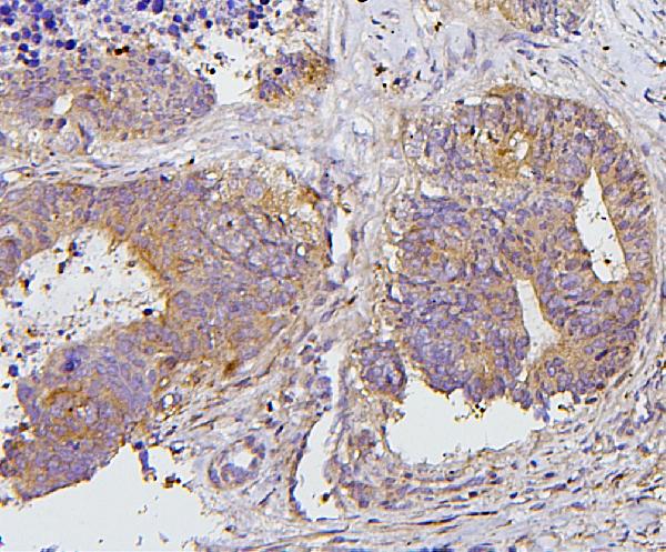 Figure 4. IHC analysis of PRKCD using anti-PRKCD antibody (A00822-1). PRKCD was detected in paraffin-embedded section of human colon cancer tissues. Heat mediated antigen retrieval was performed in citrate buffer (pH6, epitope retrieval solution) for 20 mins. The tissue section was blocked with 10% goat serum. The tissue section was then incubated with 1microg/ml rabbit anti-PRKCD Antibody (A00822-1) overnight at 4°C. Biotinylated goat anti-rabbit IgG was used as secondary antibody and incubated for 30 minutes at 37°C. The tissue section was developed using Strepavidin-Biotin-Complex (SABC)(Catalog # SA1022) with DAB as the chromogen.
