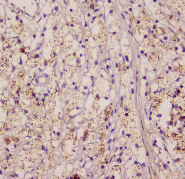 IHC analysis of EML4 using anti-EML4 antibody (A00930-1). EML4 was detected in paraffin-embedded section of human appendicitis tissue. Heat mediated antigen retrieval was performed in citrate buffer (pH6, epitope retrieval solution) for 20 mins. The tissue section was blocked with 10% goat serum. The tissue section was then incubated with 1μg/ml rabbit anti-EML4 Antibody (A00930-1) overnight at 4°C. Biotinylated goat anti-rabbit IgG was used as secondary antibody and incubated for 30 minutes at 37°C. The tissue section was developed using Strepavidin-Biotin-Complex (SABC)(Catalog # SA1022) with DAB as the chromogen.