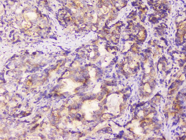 IHC analysis of EML4 using anti-EML4 antibody (A00930-1). EML4 was detected in paraffin-embedded section of human gastric cancer tissue. Heat mediated antigen retrieval was performed in citrate buffer (pH6, epitope retrieval solution) for 20 mins. The tissue section was blocked with 10% goat serum. The tissue section was then incubated with 1μg/ml rabbit anti-EML4 Antibody (A00930-1) overnight at 4°C. Biotinylated goat anti-rabbit IgG was used as secondary antibody and incubated for 30 minutes at 37°C. The tissue section was developed using Strepavidin-Biotin-Complex (SABC)(Catalog # SA1022) with DAB as the chromogen.