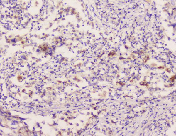 IHC analysis of EML4 using anti-EML4 antibody (A00930-1). EML4 was detected in paraffin-embedded section of human lung cancer tissue. Heat mediated antigen retrieval was performed in citrate buffer (pH6, epitope retrieval solution) for 20 mins. The tissue section was blocked with 10% goat serum. The tissue section was then incubated with 1μg/ml rabbit anti-EML4 Antibody (A00930-1) overnight at 4°C. Biotinylated goat anti-rabbit IgG was used as secondary antibody and incubated for 30 minutes at 37°C. The tissue section was developed using Strepavidin-Biotin-Complex (SABC)(Catalog # SA1022) with DAB as the chromogen.