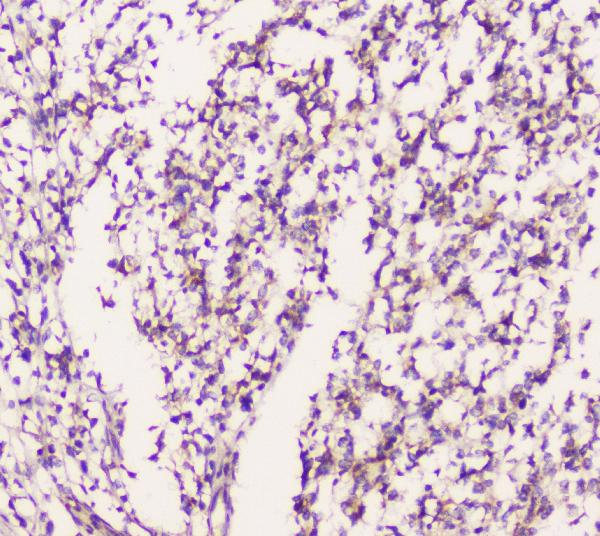 IHC analysis of EML4 using anti-EML4 antibody (A00930-1). EML4 was detected in paraffin-embedded section of human glioma tissue. Heat mediated antigen retrieval was performed in citrate buffer (pH6, epitope retrieval solution) for 20 mins. The tissue section was blocked with 10% goat serum. The tissue section was then incubated with 1μg/ml rabbit anti-EML4 Antibody (A00930-1) overnight at 4°C. Biotinylated goat anti-rabbit IgG was used as secondary antibody and incubated for 30 minutes at 37°C. The tissue section was developed using Strepavidin-Biotin-Complex (SABC)(Catalog # SA1022) with DAB as the chromogen.