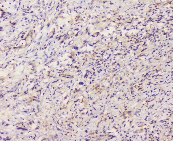 IHC analysis of EML4 using anti-EML4 antibody (A00930-1). EML4 was detected in paraffin-embedded section of human rectal cancer tissue. Heat mediated antigen retrieval was performed in citrate buffer (pH6, epitope retrieval solution) for 20 mins. The tissue section was blocked with 10% goat serum. The tissue section was then incubated with 1μg/ml rabbit anti-EML4 Antibody (A00930-1) overnight at 4°C. Biotinylated goat anti-rabbit IgG was used as secondary antibody and incubated for 30 minutes at 37°C. The tissue section was developed using Strepavidin-Biotin-Complex (SABC)(Catalog # SA1022) with DAB as the chromogen.