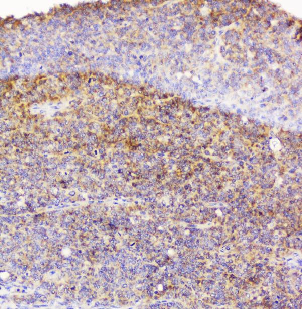 IHC analysis of EML4 using anti-EML4 antibody (A00930-1). EML4 was detected in paraffin-embedded section of human sarcoma tissue. Heat mediated antigen retrieval was performed in citrate buffer (pH6, epitope retrieval solution) for 20 mins. The tissue section was blocked with 10% goat serum. The tissue section was then incubated with 1μg/ml rabbit anti-EML4 Antibody (A00930-1) overnight at 4°C. Biotinylated goat anti-rabbit IgG was used as secondary antibody and incubated for 30 minutes at 37°C. The tissue section was developed using Strepavidin-Biotin-Complex (SABC)(Catalog # SA1022) with DAB as the chromogen.