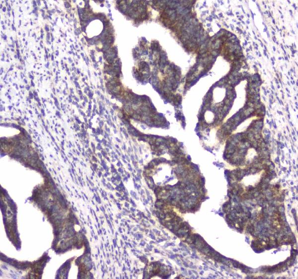 Figure 3. IHC analysis of CLPX using anti-CLPX antibody (A00978-1). CLPX was detected in paraffin-embedded section of human rectal cancer tissue. Heat mediated antigen retrieval was performed in citrate buffer (pH6, epitope retrieval solution) for 20 mins. The tissue section was blocked with 10% goat serum. The tissue section was then incubated with 1microg/ml rabbit anti-CLPX Antibody (A00978-1) overnight at 4°C. Biotinylated goat anti-rabbit IgG was used as secondary antibody and incubated for 30 minutes at 37°C. The tissue section was developed using Strepavidin-Biotin-Complex (SABC)(Catalog # SA1022) with DAB as the chromogen.