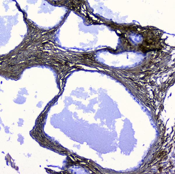 IHC analysis of Lumican using anti-Lumican antibody (A01034-1). Lumican was detected in paraffin-embedded section of human pancreatic cancer tissue. Heat mediated antigen retrieval was performed in citrate buffer (pH6, epitope retrieval solution) for 20 mins. The tissue section was blocked with 10% goat serum. The tissue section was then incubated with 1μg/ml rabbit anti-Lumican Antibody (A01034-1) overnight at 4°C. Biotinylated goat anti-rabbit IgG was used as secondary antibody and incubated for 30 minutes at 37°C. The tissue section was developed using Strepavidin-Biotin-Complex (SABC)(Catalog # SA1022) with DAB as the chromogen.