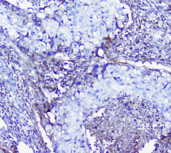 IHC analysis of Lumican using anti-Lumican antibody (A01034-1). Lumican was detected in paraffin-embedded section of human lung cancer tissue. Heat mediated antigen retrieval was performed in citrate buffer (pH6, epitope retrieval solution) for 20 mins. The tissue section was blocked with 10% goat serum. The tissue section was then incubated with 1μg/ml rabbit anti-Lumican Antibody (A01034-1) overnight at 4°C. Biotinylated goat anti-rabbit IgG was used as secondary antibody and incubated for 30 minutes at 37°C. The tissue section was developed using Strepavidin-Biotin-Complex (SABC)(Catalog # SA1022) with DAB as the chromogen.