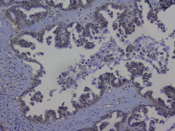 IHC analysis of NRF1 using anti-NRF1 antibody (A01129-2). NRF1 was detected in paraffin-embedded section of human ovary cancer tissue. Heat mediated antigen retrieval was performed in citrate buffer (pH6, epitope retrieval solution) for 20 mins. The tissue section was blocked with 10% goat serum. The tissue section was then incubated with 1μg/ml rabbit anti-NRF1 Antibody (A01129-2) overnight at 4°C. Biotinylated goat anti-rabbit IgG was used as secondary antibody and incubated for 30 minutes at 37°C. The tissue section was developed using Strepavidin-Biotin-Complex (SABC)(Catalog # SA1022) with DAB as the chromogen.
