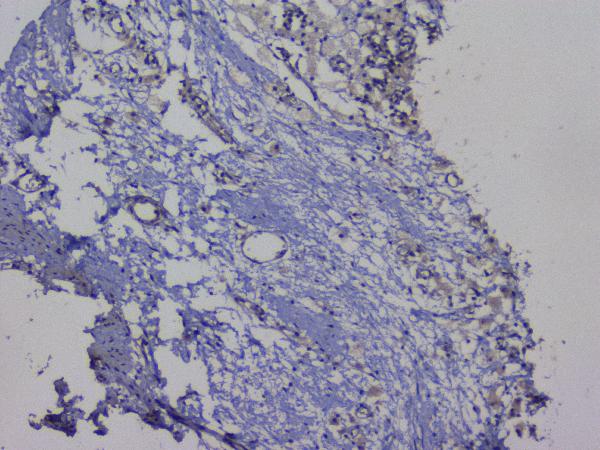 IHC analysis of NRF1 using anti-NRF1 antibody (A01129-2). NRF1 was detected in paraffin-embedded section of human appendicitis tissue. Heat mediated antigen retrieval was performed in citrate buffer (pH6, epitope retrieval solution) for 20 mins. The tissue section was blocked with 10% goat serum. The tissue section was then incubated with 1μg/ml rabbit anti-NRF1 Antibody (A01129-2) overnight at 4°C. Biotinylated goat anti-rabbit IgG was used as secondary antibody and incubated for 30 minutes at 37°C. The tissue section was developed using Strepavidin-Biotin-Complex (SABC)(Catalog # SA1022) with DAB as the chromogen.