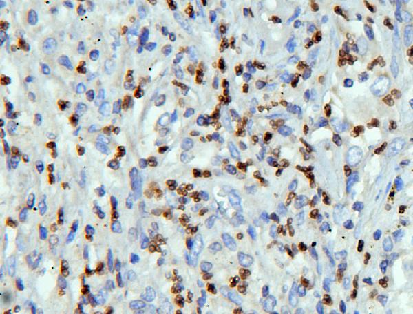 Figure 3. IHC analysis of LBR using anti-LBR antibody (A01238-2). LBR was detected in paraffin-embedded section of human lung cancer tissues. Heat mediated antigen retrieval was performed in citrate buffer (pH6, epitope retrieval solution) for 20 mins. The tissue section was blocked with 10% goat serum. The tissue section was then incubated with 1microg/ml rabbit anti-LBR Antibody (A01238-2) overnight at 4°C. Biotinylated goat anti-rabbit IgG was used as secondary antibody and incubated for 30 minutes at 37°C. The tissue section was developed using Strepavidin-Biotin-Complex (SABC)(Catalog # SA1022) with DAB as the chromogen. Figure 3. IHC analysis of LBR using anti-LBR antibody (A01238-2). LBR was detected in paraffin-embedded section of human lung cancer tissues. Heat mediated antigen retrieval was performed in citrate buffer (pH6, epitope retrieval solution) for 20 mins. The tissue section was blocked with 10% goat serum. The tissue section was then incubated with 1microg/ml rabbit anti-LBR Antibody (A01238-2) overnight at 4°C. Biotinylated goat anti-rabbit IgG was used as secondary antibody and incubated for 30 minutes at 37°C. The tissue section was developed using Strepavidin-Biotin-Complex (SABC)(Catalog # SA1022) with DAB as the chromogen.