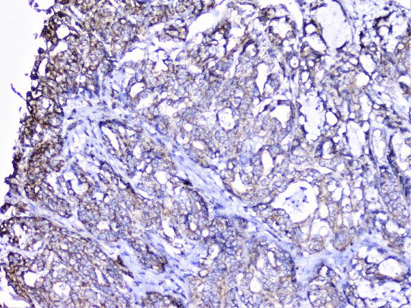 IHC analysis of cortactin using anti-cortactin antibody (A01253-1). cortactin was detected in paraffin-embedded section of human gastric cancer tissue. Heat mediated antigen retrieval was performed in citrate buffer (pH6, epitope retrieval solution) for 20 mins. The tissue section was blocked with 10% goat serum. The tissue section was then incubated with 1μg/ml rabbit anti-cortactin Antibody (A01253-1) overnight at 4°C. Biotinylated goat anti-rabbit IgG was used as secondary antibody and incubated for 30 minutes at 37°C. The tissue section was developed using Strepavidin-Biotin-Complex (SABC)(Catalog # SA1022) with DAB as the chromogen.