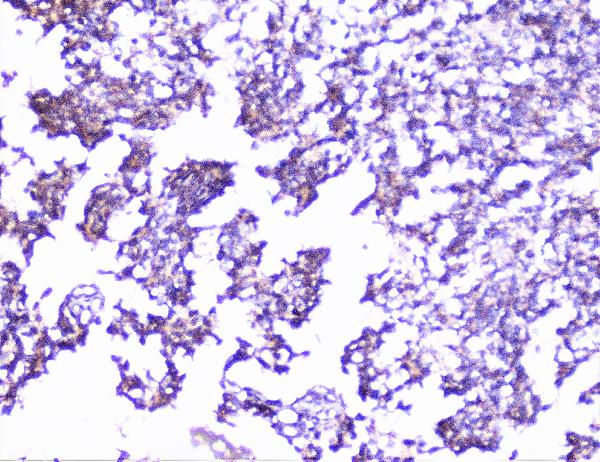 IHC analysis of cortactin using anti-cortactin antibody (A01253-1). cortactin was detected in paraffin-embedded section of human glioma tissue. Heat mediated antigen retrieval was performed in citrate buffer (pH6, epitope retrieval solution) for 20 mins. The tissue section was blocked with 10% goat serum. The tissue section was then incubated with 1μg/ml rabbit anti-cortactin Antibody (A01253-1) overnight at 4°C. Biotinylated goat anti-rabbit IgG was used as secondary antibody and incubated for 30 minutes at 37°C. The tissue section was developed using Strepavidin-Biotin-Complex (SABC)(Catalog # SA1022) with DAB as the chromogen.