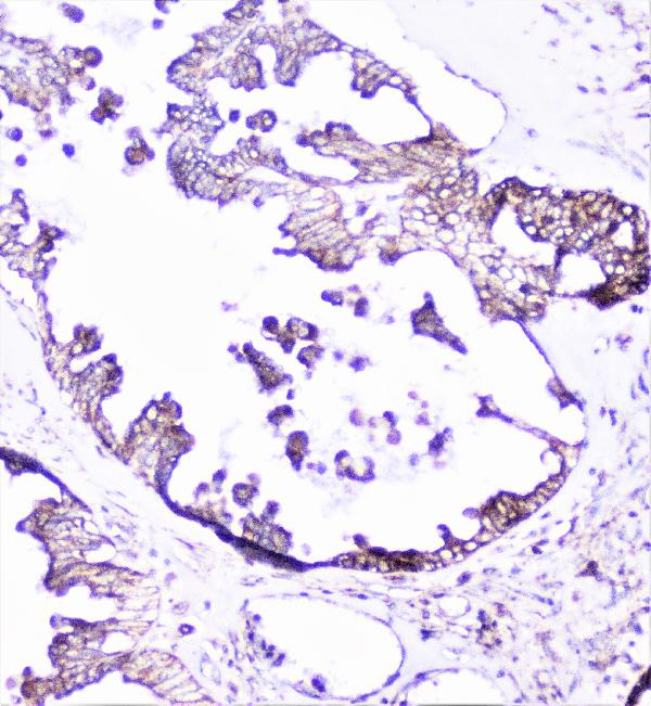 IHC analysis of cortactin using anti-cortactin antibody (A01253-1). cortactin was detected in paraffin-embedded section of human ovary cancer tissue. Heat mediated antigen retrieval was performed in citrate buffer (pH6, epitope retrieval solution) for 20 mins. The tissue section was blocked with 10% goat serum. The tissue section was then incubated with 1μg/ml rabbit anti-cortactin Antibody (A01253-1) overnight at 4°C. Biotinylated goat anti-rabbit IgG was used as secondary antibody and incubated for 30 minutes at 37°C. The tissue section was developed using Strepavidin-Biotin-Complex (SABC)(Catalog # SA1022) with DAB as the chromogen.