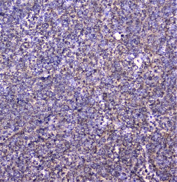 IHC analysis of cortactin using anti-cortactin antibody (A01253-1). cortactin was detected in paraffin-embedded section of human sarcoma tissue. Heat mediated antigen retrieval was performed in citrate buffer (pH6, epitope retrieval solution) for 20 mins. The tissue section was blocked with 10% goat serum. The tissue section was then incubated with 1μg/ml rabbit anti-cortactin Antibody (A01253-1) overnight at 4°C. Biotinylated goat anti-rabbit IgG was used as secondary antibody and incubated for 30 minutes at 37°C. The tissue section was developed using Strepavidin-Biotin-Complex (SABC)(Catalog # SA1022) with DAB as the chromogen.