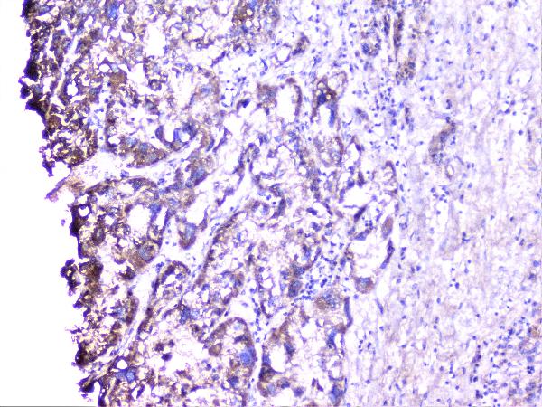 IHC analysis of cortactin using anti-cortactin antibody (A01253-1). cortactin was detected in paraffin-embedded section of human liver cancer tissue. Heat mediated antigen retrieval was performed in citrate buffer (pH6, epitope retrieval solution) for 20 mins. The tissue section was blocked with 10% goat serum. The tissue section was then incubated with 1μg/ml rabbit anti-cortactin Antibody (A01253-1) overnight at 4°C. Biotinylated goat anti-rabbit IgG was used as secondary antibody and incubated for 30 minutes at 37°C. The tissue section was developed using Strepavidin-Biotin-Complex (SABC)(Catalog # SA1022) with DAB as the chromogen.