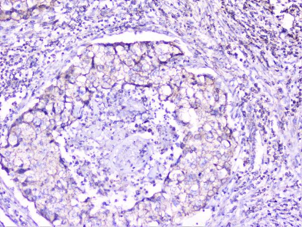 IHC analysis of cortactin using anti-cortactin antibody (A01253-1). cortactin was detected in paraffin-embedded section of human lung cancer tissue. Heat mediated antigen retrieval was performed in citrate buffer (pH6, epitope retrieval solution) for 20 mins. The tissue section was blocked with 10% goat serum. The tissue section was then incubated with 1μg/ml rabbit anti-cortactin Antibody (A01253-1) overnight at 4°C. Biotinylated goat anti-rabbit IgG was used as secondary antibody and incubated for 30 minutes at 37°C. The tissue section was developed using Strepavidin-Biotin-Complex (SABC)(Catalog # SA1022) with DAB as the chromogen.