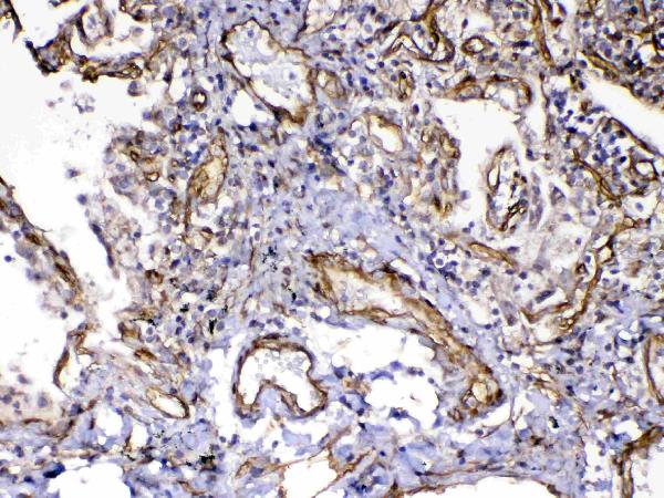 IHC analysis of VEGF Receptor 3 using anti-VEGF Receptor 3 antibody (A01276-2). VEGF Receptor 3 was detected in paraffin-embedded section of human lung cancer tissue. Heat mediated antigen retrieval was performed in citrate buffer (pH6, epitope retrieval solution) for 20 mins. The tissue section was blocked with 10% goat serum. The tissue section was then incubated with 1ug/ml rabbit anti-VEGF Receptor 3 Antibody (A01276-2) overnight at 4 Biotinylated goat anti-rabbit IgG was used as secondary antibody and incubated for 30 minutes at 37 The tissue section was developed using Strepavidin-Biotin-Complex (SABC)(Catalog # SA1022) with DAB as the chromogen.