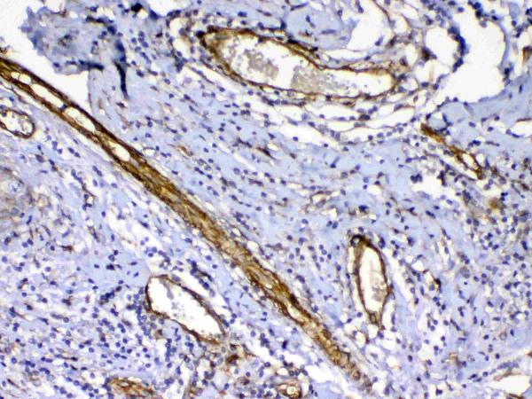 IHC analysis of VEGF Receptor 3 using anti-VEGF Receptor 3 antibody (A01276-2). VEGF Receptor 3 was detected in paraffin-embedded section of human mammary cancer tissue. Heat mediated antigen retrieval was performed in citrate buffer (pH6, epitope retrieval solution) for 20 mins. The tissue section was blocked with 10% goat serum. The tissue section was then incubated with 1ug/ml rabbit anti-VEGF Receptor 3 Antibody (A01276-2) overnight at 4 Biotinylated goat anti-rabbit IgG was used as secondary antibody and incubated for 30 minutes at 37 The tissue section was developed using Strepavidin-Biotin-Complex (SABC)(Catalog # SA1022) with DAB as the chromogen.