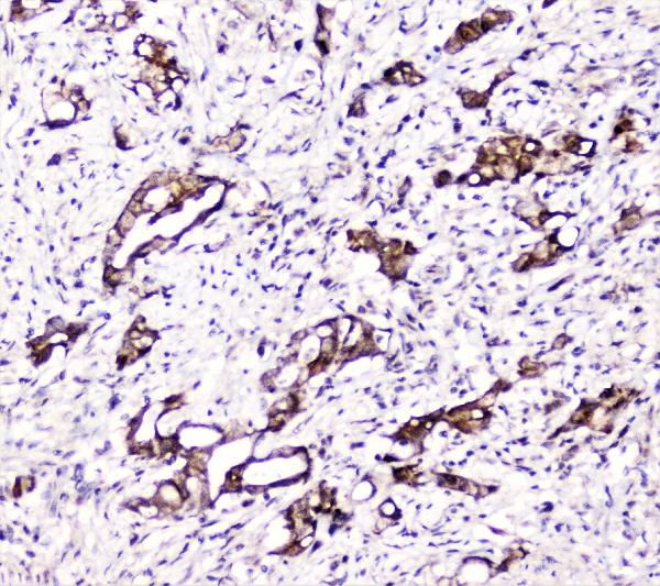 IHC analysis of DDT using anti-DDT antibody (A01354). DDT was detected in paraffin-embedded section of human intestinal cancer tissue. Heat mediated antigen retrieval was performed in citrate buffer (pH6, epitope retrieval solution) for 20 mins. The tissue section was blocked with 10% goat serum. The tissue section was then incubated with 2μg/ml rabbit anti-DDT Antibody (A01354) overnight at 4°C. Biotinylated goat anti-rabbit IgG was used as secondary antibody and incubated for 30 minutes at 37°C. The tissue section was developed using Strepavidin-Biotin-Complex (SABC)(Catalog # SA1022) with DAB as the chromogen.
