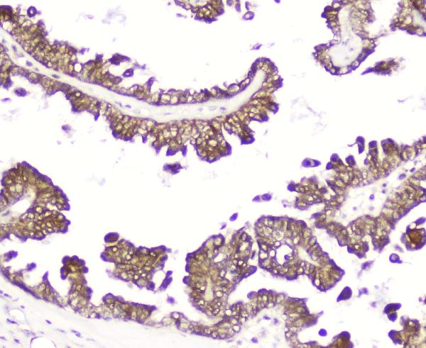 IHC analysis of DDT using anti-DDT antibody (A01354). DDT was detected in paraffin-embedded section of human ovary cancer tissue. Heat mediated antigen retrieval was performed in citrate buffer (pH6, epitope retrieval solution) for 20 mins. The tissue section was blocked with 10% goat serum. The tissue section was then incubated with 2μg/ml rabbit anti-DDT Antibody (A01354) overnight at 4°C. Biotinylated goat anti-rabbit IgG was used as secondary antibody and incubated for 30 minutes at 37°C. The tissue section was developed using Strepavidin-Biotin-Complex (SABC)(Catalog # SA1022) with DAB as the chromogen.