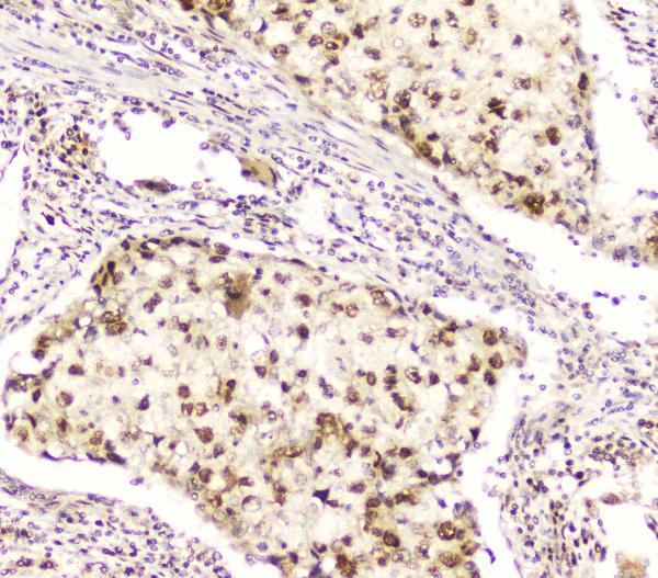 IHC analysis of DDT using anti-DDT antibody (A01354). DDT was detected in paraffin-embedded section of human lung cancer tissue. Heat mediated antigen retrieval was performed in citrate buffer (pH6, epitope retrieval solution) for 20 mins. The tissue section was blocked with 10% goat serum. The tissue section was then incubated with 2μg/ml rabbit anti-DDT Antibody (A01354) overnight at 4°C. Biotinylated goat anti-rabbit IgG was used as secondary antibody and incubated for 30 minutes at 37°C. The tissue section was developed using Strepavidin-Biotin-Complex (SABC)(Catalog # SA1022) with DAB as the chromogen.