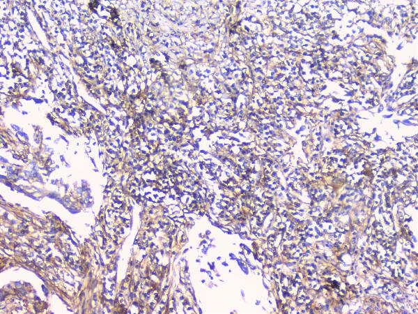IHC analysis of FCGR2A using anti-FCGR2A antibody (A01450-1). FCGR2A was detected in paraffin-embedded section of human lung cancer tissue. Heat mediated antigen retrieval was performed in citrate buffer (pH6, epitope retrieval solution) for 20 mins. The tissue section was blocked with 10% goat serum. The tissue section was then incubated with 1μg/ml rabbit anti-FCGR2A Antibody (A01450-1) overnight at 4°C. Biotinylated goat anti-rabbit IgG was used as secondary antibody and incubated for 30 minutes at 37°C. The tissue section was developed using Strepavidin-Biotin-Complex (SABC)(Catalog # SA1022) with DAB as the chromogen.