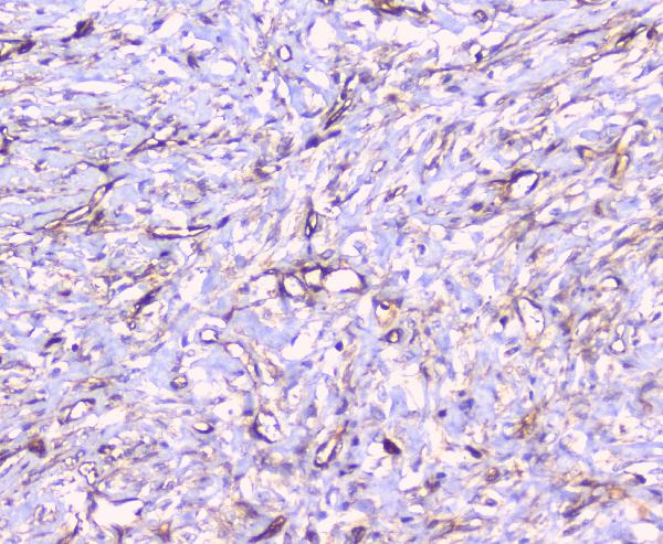 IHC analysis of FCGR2A using anti-FCGR2A antibody (A01450-1). FCGR2A was detected in paraffin-embedded section of human mammary cancer tissue. Heat mediated antigen retrieval was performed in citrate buffer (pH6, epitope retrieval solution) for 20 mins. The tissue section was blocked with 10% goat serum. The tissue section was then incubated with 1μg/ml rabbit anti-FCGR2A Antibody (A01450-1) overnight at 4°C. Biotinylated goat anti-rabbit IgG was used as secondary antibody and incubated for 30 minutes at 37°C. The tissue section was developed using Strepavidin-Biotin-Complex (SABC)(Catalog # SA1022) with DAB as the chromogen.
