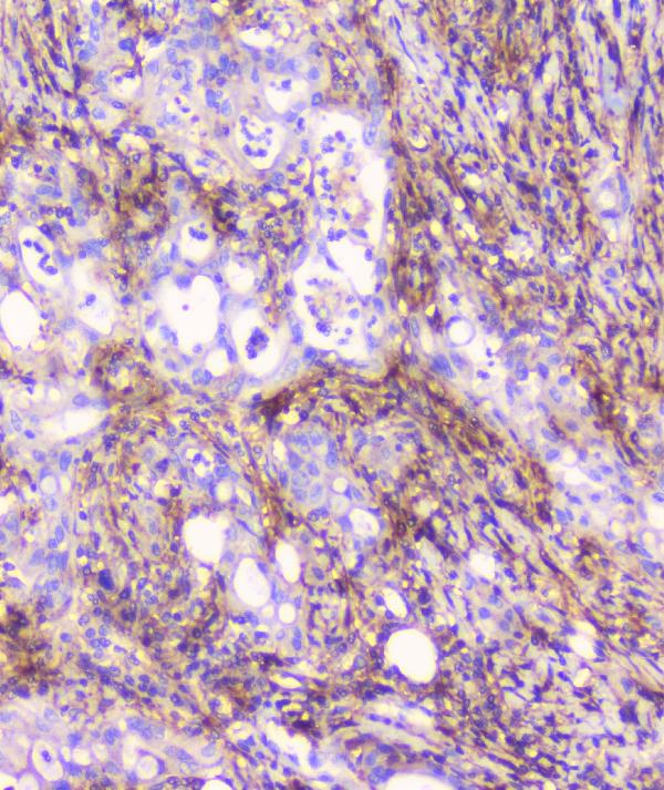 IHC analysis of FCGR2A using anti-FCGR2A antibody (A01450-1). FCGR2A was detected in paraffin-embedded section of human rectal cancer tissue. Heat mediated antigen retrieval was performed in citrate buffer (pH6, epitope retrieval solution) for 20 mins. The tissue section was blocked with 10% goat serum. The tissue section was then incubated with 1μg/ml rabbit anti-FCGR2A Antibody (A01450-1) overnight at 4°C. Biotinylated goat anti-rabbit IgG was used as secondary antibody and incubated for 30 minutes at 37°C. The tissue section was developed using Strepavidin-Biotin-Complex (SABC)(Catalog # SA1022) with DAB as the chromogen.
