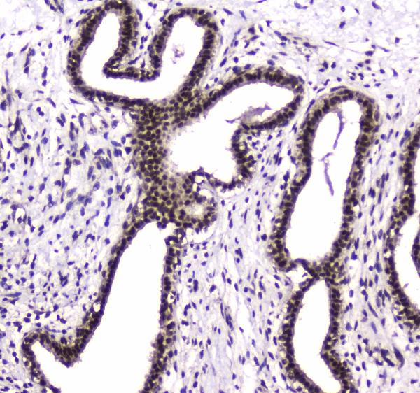 Figure 2. IHC analysis of PARN using anti-PARN antibody (A01501-2). PARN was detected in paraffin-embedded section of human mammary cancer tissue. Heat mediated antigen retrieval was performed in citrate buffer (pH6, epitope retrieval solution) for 20 mins. The tissue section was blocked with 10% goat serum. The tissue section was then incubated with 1microg/ml rabbit anti-PARN Antibody (A01501-2) overnight at 4°C. Biotinylated goat anti-rabbit IgG was used as secondary antibody and incubated for 30 minutes at 37°C. The tissue section was developed using Strepavidin-Biotin-Complex (SABC)(Catalog # SA1022) with DAB as the chromogen. Figure 2. IHC analysis of PARN using anti-PARN antibody (A01501-2). PARN was detected in paraffin-embedded section of human mammary cancer tissue. Heat mediated antigen retrieval was performed in citrate buffer (pH6, epitope retrieval solution) for 20 mins. The tissue section was blocked with 10% goat serum. The tissue section was then incubated with 1microg/ml rabbit anti-PARN Antibody (A01501-2) overnight at 4°C. Biotinylated goat anti-rabbit IgG was used as secondary antibody and incubated for 30 minutes at 37°C. The tissue section was developed using Strepavidin-Biotin-Complex (SABC)(Catalog # SA1022) with DAB as the chromogen.