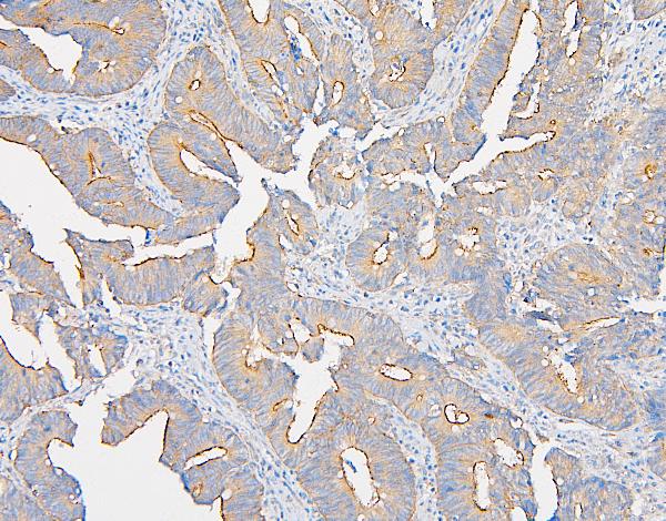IHC analysis of IQGAP1 using anti-IQGAP1 antibody (A01603). IQGAP1 was detected in paraffin-embedded section of human intestinal cancer tissue. Heat mediated antigen retrieval was performed in citrate buffer (pH6, epitope retrieval solution) for 20 mins. The tissue section was blocked with 10% goat serum. The tissue section was then incubated with 1μg/ml rabbit anti-IQGAP1 Antibody (A01603) overnight at 4°C. Biotinylated goat anti-rabbit IgG was used as secondary antibody and incubated for 30 minutes at 37°C. The tissue section was developed using Strepavidin-Biotin-Complex (SABC)(Catalog # SA1022) with DAB as the chromogen.