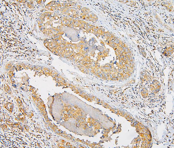 IHC analysis of IQGAP1 using anti-IQGAP1 antibody (A01603). IQGAP1 was detected in paraffin-embedded section of human mammary cancer tissue. Heat mediated antigen retrieval was performed in citrate buffer (pH6, epitope retrieval solution) for 20 mins. The tissue section was blocked with 10% goat serum. The tissue section was then incubated with 1μg/ml rabbit anti-IQGAP1 Antibody (A01603) overnight at 4°C. Biotinylated goat anti-rabbit IgG was used as secondary antibody and incubated for 30 minutes at 37°C. The tissue section was developed using Strepavidin-Biotin-Complex (SABC)(Catalog # SA1022) with DAB as the chromogen.