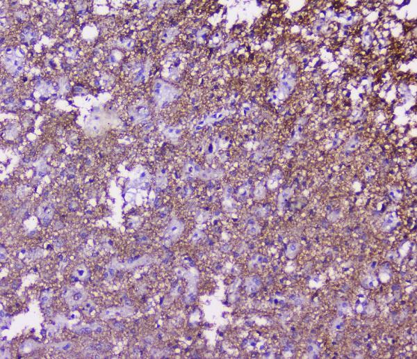 IHC analysis of SNAP25 using anti-SNAP25 antibody (A01625). SNAP25 was detected in paraffin-embedded section of human glioma tissue. Heat mediated antigen retrieval was performed in citrate buffer (pH6, epitope retrieval solution) for 20 mins. The tissue section was blocked with 10% goat serum. The tissue section was then incubated with 2μg/ml rabbit anti-SNAP25 Antibody (A01625) overnight at 4°C. Biotinylated goat anti-rabbit IgG was used as secondary antibody and incubated for 30 minutes at 37°C. The tissue section was developed using Strepavidin-Biotin-Complex (SABC)(Catalog # SA1022) with DAB as the chromogen.