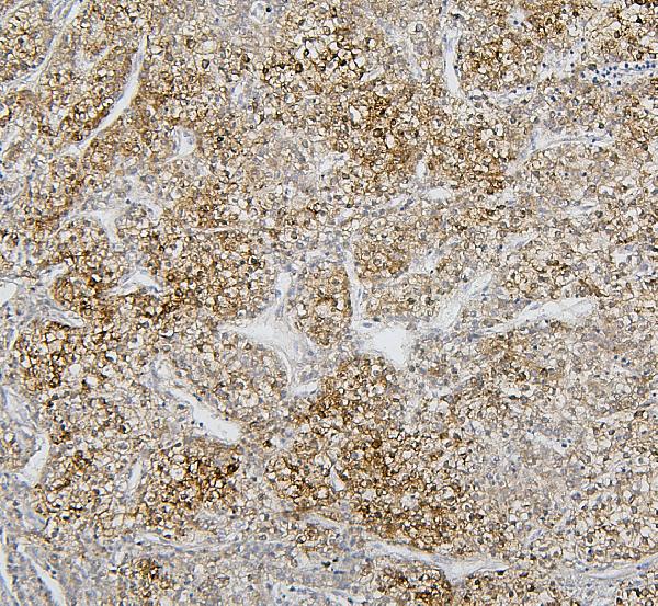 Figure 2. IHC analysis of CYP2C19 using anti-CYP2C19 antibody (A02102-2). CYP2C19 was detected in paraffin-embedded section of human liver cancer tissues. Heat mediated antigen retrieval was performed in citrate buffer (pH6, epitope retrieval solution) for 20 mins. The tissue section was blocked with 10% goat serum. The tissue section was then incubated with 1microg/ml rabbit anti-CYP2C19 Antibody (A02102-2) overnight at 4°C. Biotinylated goat anti-rabbit IgG was used as secondary antibody and incubated for 30 minutes at 37°C. The tissue section was developed using Strepavidin-Biotin-Complex (SABC)(Catalog # SA1022) with DAB as the chromogen. Figure 2. IHC analysis of CYP2C19 using anti-CYP2C19 antibody (A02102-2). CYP2C19 was detected in paraffin-embedded section of human liver cancer tissues. Heat mediated antigen retrieval was performed in citrate buffer (pH6, epitope retrieval solution) for 20 mins. The tissue section was blocked with 10% goat serum. The tissue section was then incubated with 1microg/ml rabbit anti-CYP2C19 Antibody (A02102-2) overnight at 4°C. Biotinylated goat anti-rabbit IgG was used as secondary antibody and incubated for 30 minutes at 37°C. The tissue section was developed using Strepavidin-Biotin-Complex (SABC)(Catalog # SA1022) with DAB as the chromogen.