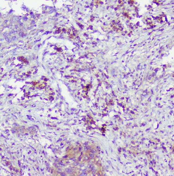 IHC analysis of Caspase-2 using anti-Caspase-2 antibody (A02384-1). Caspase-2 was detected in paraffin-embedded section of human lung cancer tissue. Heat mediated antigen retrieval was performed in citrate buffer (pH6, epitope retrieval solution) for 20 mins. The tissue section was blocked with 10% goat serum. The tissue section was then incubated with 1μg/ml rabbit anti-Caspase-2 Antibody (A02384-1) overnight at 4°C. Biotinylated goat anti-rabbit IgG was used as secondary antibody and incubated for 30 minutes at 37°C. The tissue section was developed using Strepavidin-Biotin-Complex (SABC)(Catalog # SA1022) with DAB as the chromogen.