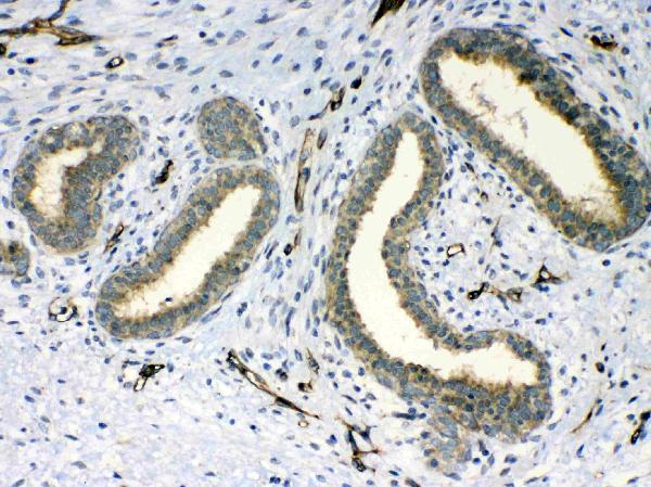 Figure 2. IHC analysis of PPID using anti-PPID antibody (A02424). PPID was detected in paraffin-embedded section of human mammary cancer tissue. Heat mediated antigen retrieval was performed in citrate buffer (pH6, epitope retrieval solution) for 20 mins. The tissue section was blocked with 10% goat serum. The tissue section was then incubated with 1microg/ml rabbit anti-PPID Antibody (A02424) overnight at 4°C. Biotinylated goat anti-rabbit IgG was used as secondary antibody and incubated for 30 minutes at 37°C. The tissue section was developed using Strepavidin-Biotin-Complex (SABC)(Catalog # SA1022) with DAB as the chromogen.